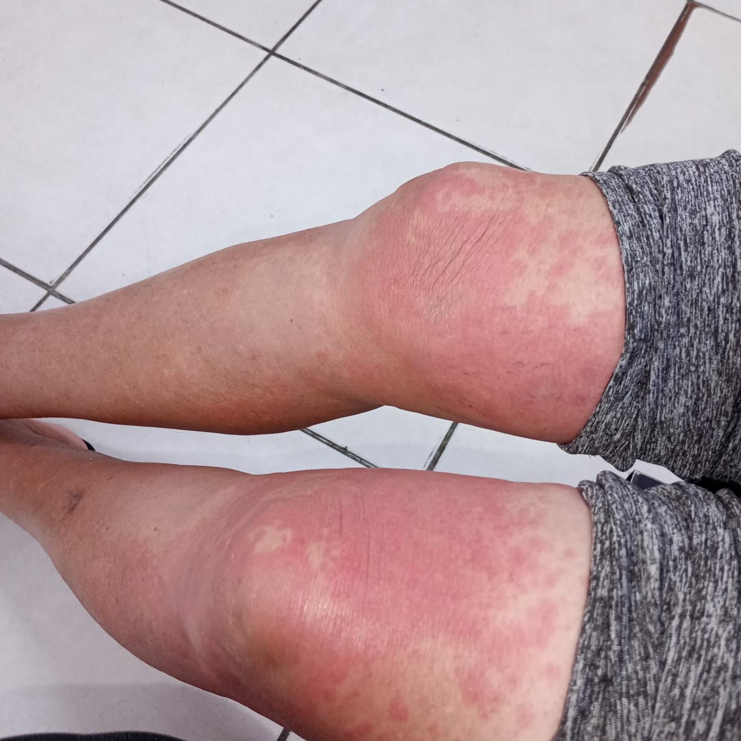 Paciente relata dificuldade em realizar exame de sangue na UPA Zaira