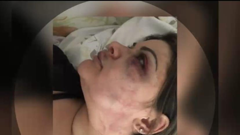 Em 2022, circularam nas redes sociais fotos de Renata com hematomas no rosto. Foto: Reprodução