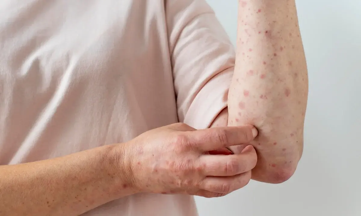 MAUÁ E SANTO ANDRÉ REGISTRAM MPOX